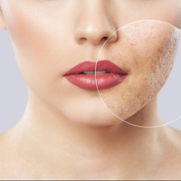 Acne scar Treatment Acne scar Treatment